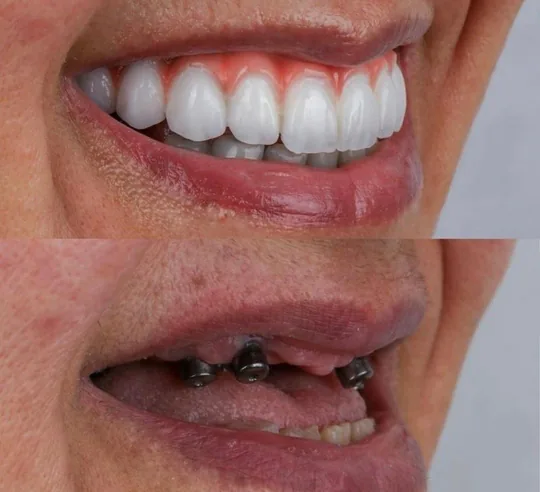 Registro do sorriso após o tratamento na imagem superior e antes do tratamento na imagem inferior.
